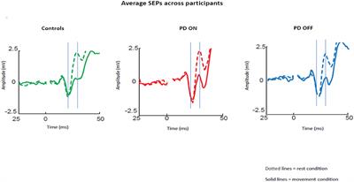 Dopaminergic Modulation of Sensory Attenuation in Parkinson's Disease: Is There an Underlying Modulation of Beta Power?